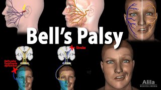 Bells Palsy Pathophysiology Symptoms Diagnosis and Treatment Animation [upl. by Ailaro41]