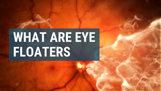 What Are Eye Floaters [upl. by Gerome]